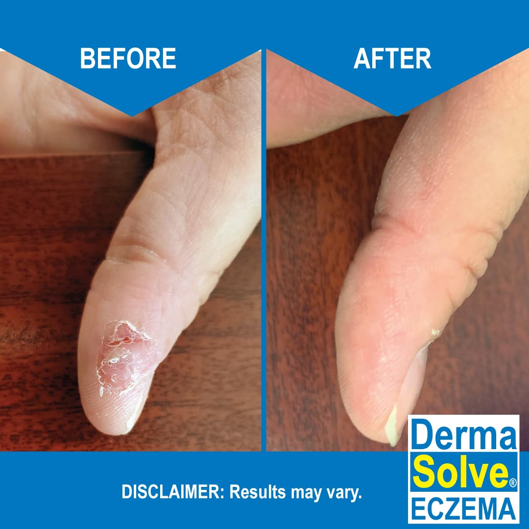 Dermasolve Eczema Relief Body Wash (2 Pack) | Protects, Moisturizes, and Repairs Skin - Kids