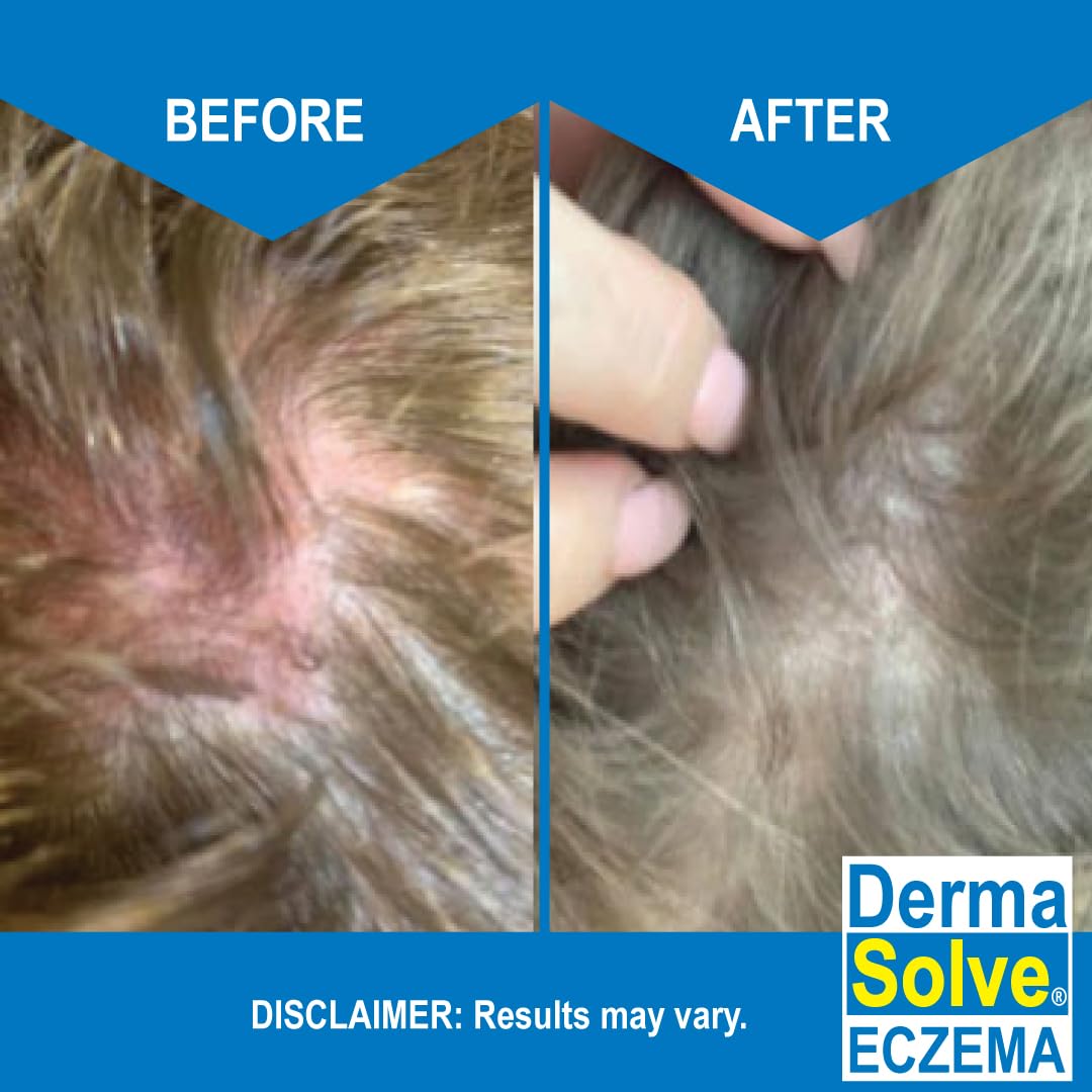 Eczema Shampoo & Conditioner (Combo Pack) - Flare Control Scalp & flake Relief Therapy that