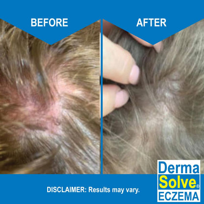 Eczema Shampoo & Conditioner (Combo Pack) - Flare Control Scalp & flake Relief Therapy that