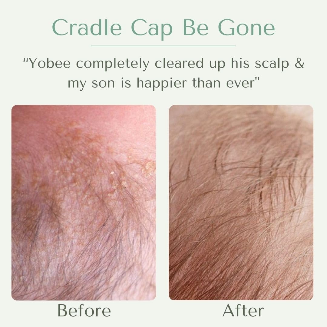 Yobee Ultra Gentle Soothing Scalp Mask - Dry Scalp Treatment Hair Mask Safe For Sensitive Baby Skin