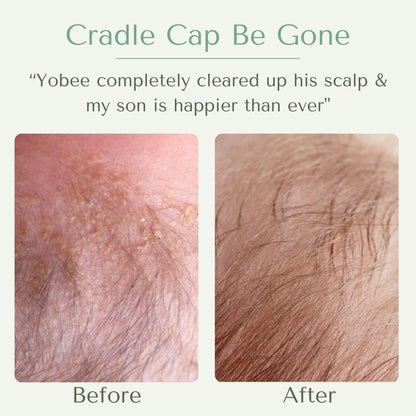 Yobee Ultra Gentle Soothing Scalp Mask - Dry Scalp Treatment Hair Mask Safe For Sensitive Baby Skin