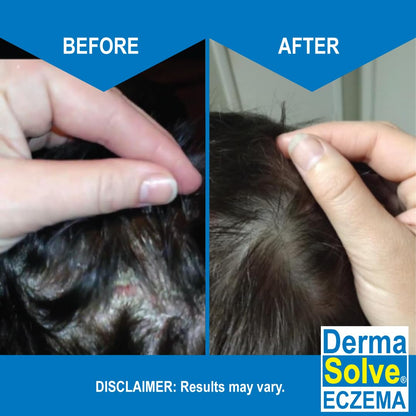 Eczema Shampoo & Conditioner (Combo Pack) - Flare Control Scalp & flake Relief Therapy that
